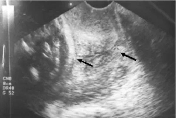 Fig. 2. Fetal sonography at IUP 32 weeks shows three echogenic nodules(about 8×7 mm, 8×7 mm and 10×7 mm).
