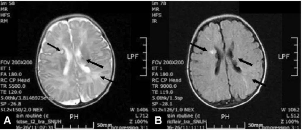 Fig. 4. Contrast axial T2 (A) and T1 (B) weighted image show multiple small subependymal tubers in the both lateral ventricle and subcortical tuber and multiple white matter lesions in the both cerebral hemisphere.