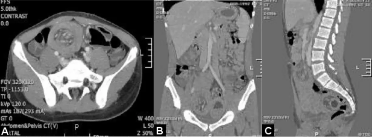 Fig. 2. Computed tomography(CT) of abdomen and pelvis(A) shows intussusception secondary to a small bowel lipoma