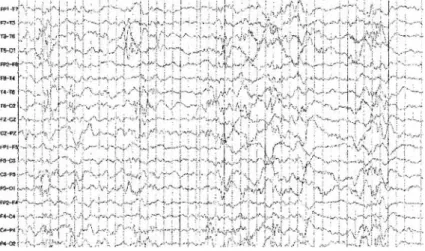 Fig. 2. Sedated sleep EEG shows frequent multifocal spikes and oc- oc-casionally, short spike wave bursts with depressed background activity are also shown.