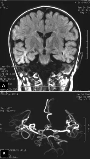 Fig. 4. (A) Brain MRI(T1-weighted image, coronal view) at the age of 23 months shows diffuse  cere-bral atrophy