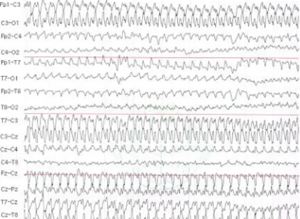 Fig. 1. These are ictal electroencephalograms of 10-days old male infant. (A) The finding shows sharp wave discharges started from left central area with movement artifacts, when the patients had the deviation of head and eyeballs to right side with mouthi