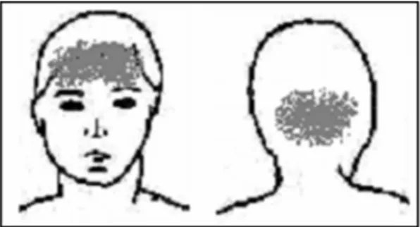 Fig. 2. Drawing depicting downward progression of the feeling of weakness in both lower legs during headache.