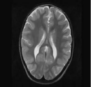 Fig. 5. MRI scan showing cerebellar atropy.