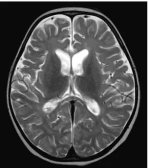 Fig. 1. Axial T2-weighted brain MRI at 18 months of age. Brain MRI showed diffuse atrophy of brain with passive dilatation of ventricles.