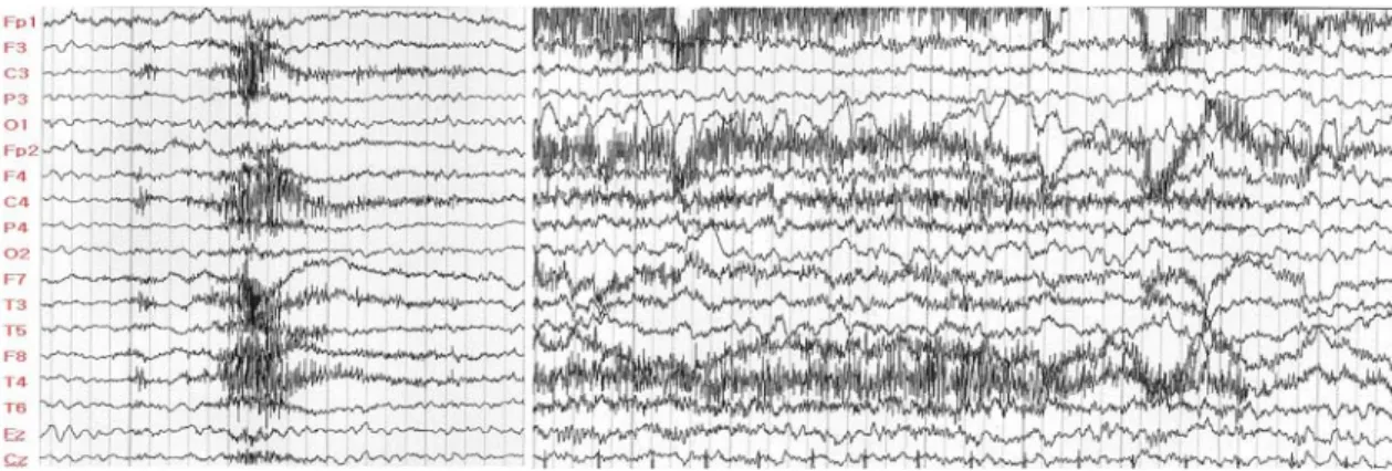 Fig. 1. Before the pentobarbital treatment, the EEG showed rapid polyspike series and subsequently tonic pattern.