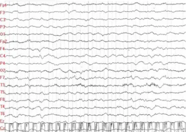 Fig. 2. The EEG showed continuous 1.5 Hz spike and slow wave discharges in the right occipital area followed by spreading to both frontal and generalized area during pentobarbital infusion.