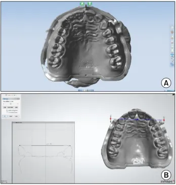 Fig.  3.  Measurement  of  digital  model.  (A)  Digital  model  using  3Shape 3DViewer software