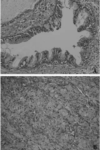 Fig. 3. The histopathologic variant in mucoepidermoid carcinoma. In A, the epidermoid and mucous cells show a close combination, with formation of cystic cavity lined by mucous cells