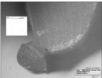 Fig.  5.  Measurement  of  marginal  gap  using  the  digital  micro  scope  (×160).