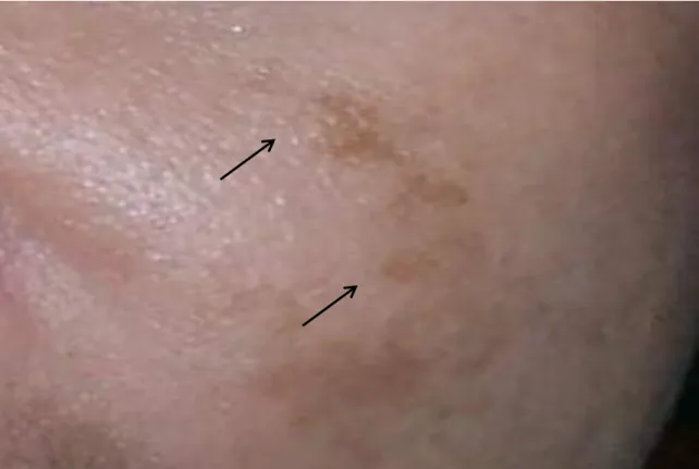 Figure  3.  Melasma,  the  most  common  hyperpigmentation  disorder  affects  about  80%  of  teenagers