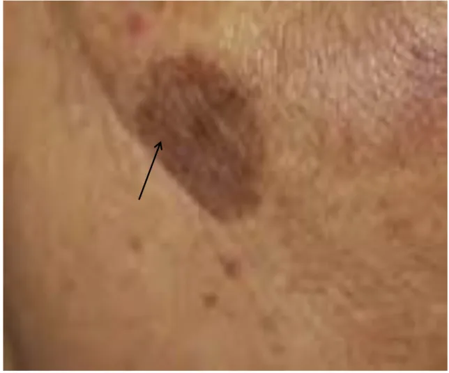 Figure 4. Solar lentigo, a disorder of hyperpigmentation