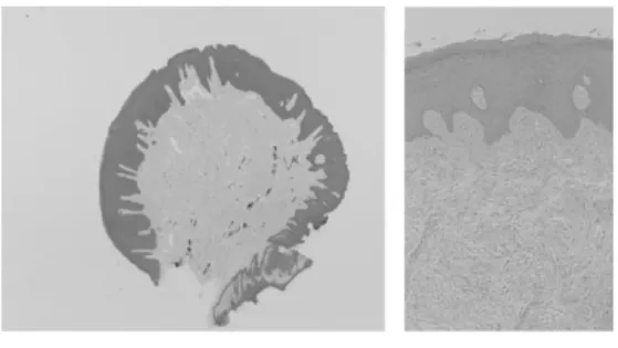 Fig. 3 . (a)  Normal oral mucosa - Positive staining in the all layers except keratinized layer (TGF- β 1, ×100)