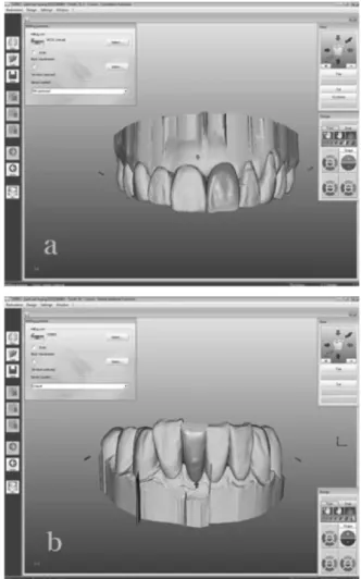 Fig. 4. Frontal view of the patient with the maxillary provisional restoration.