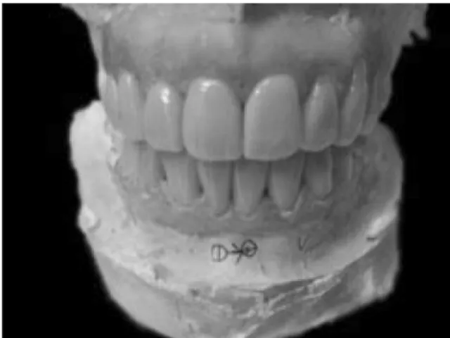 Fig. 7. Checking position of crowns in the mouth and assessing of forms, shapes and aesthetic appearance