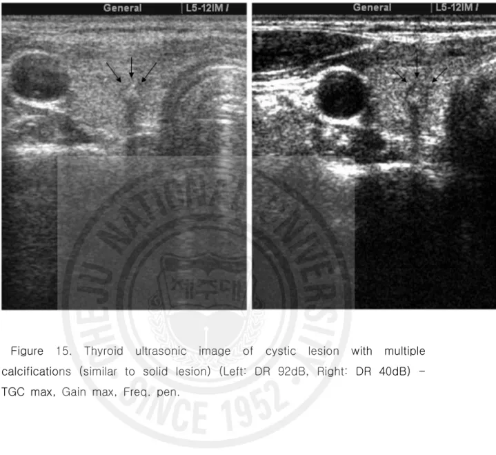 Figure  15.  Thyroid  ultrasonic  image  of  cystic  lesion  with  multiple  calcifications  (similar  to  solid  lesion)  (Left:  DR  92dB,  Right:  DR  40dB)  -  TGC  max,  Gain  max,  Freq