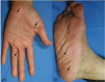 Table  1.  Lamivudine  induced  lentigo-like  pigmentation  (WHO-UMC  causality  category) 확실함 (Certain) ㆍ 의약품 등의 투여,  사용과의 전후 관계가 타당 ㆍ 다른 의약품이나 화학물질 또는 수반 질환으로 설명되지 않음 ㆍ 투여 중단 시 임상적으로 타당한 반응 ㆍ 재투여시,  약물학적 또는 현상학적으로 결정적인 경우 상당히 확실함 (probable/likely) ㆍ 의약품 