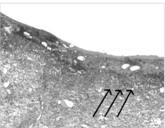 Figure 5. Light microphotograph of wound in rat skin at 5 days after induced pressure ulcer (Group III)