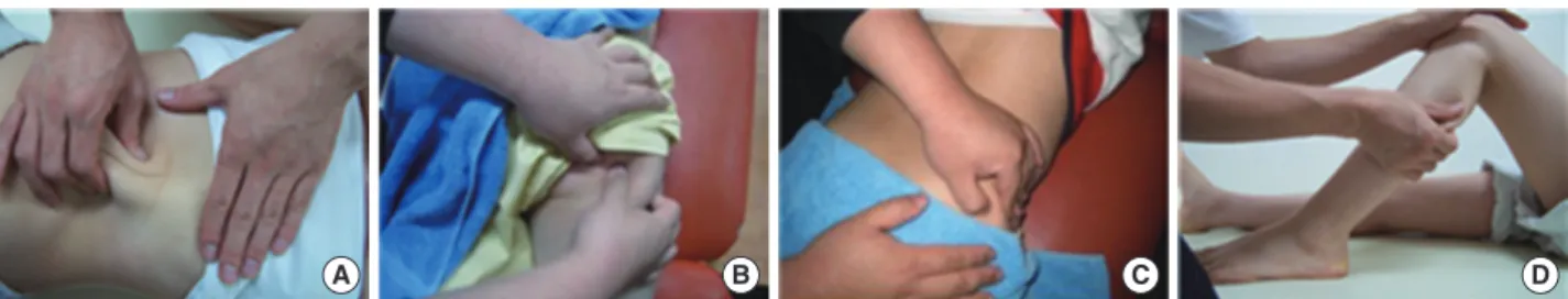 Figure 1. PMT Applied. (A) Spinous process. (B) Gluteal tuberosity. (C) Upper of gluteus