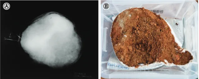 Figure 9. Non-destructive analysis (A: X-ray image, B: Collected artifact covered with soil).