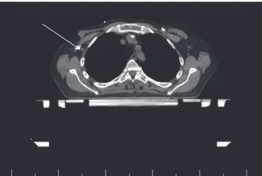 Figure 4. Radiation simulation computed tomography scan. Persistent right axillary lymphadenopathy is  indicated with an arrow.