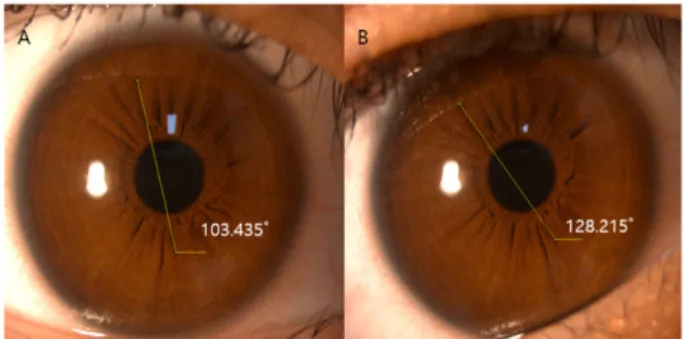 Fig. 1. An example of measuring OCR in the right eye using  iris image and Image J. 