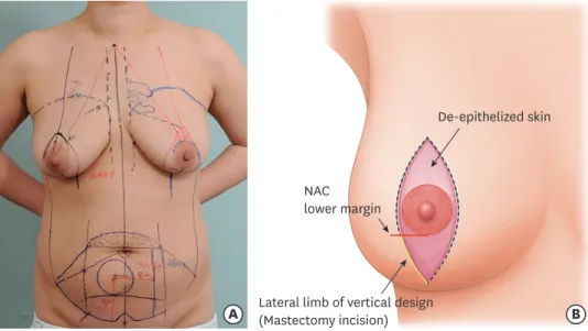 Figure 2. Representative image of flap insetting. 