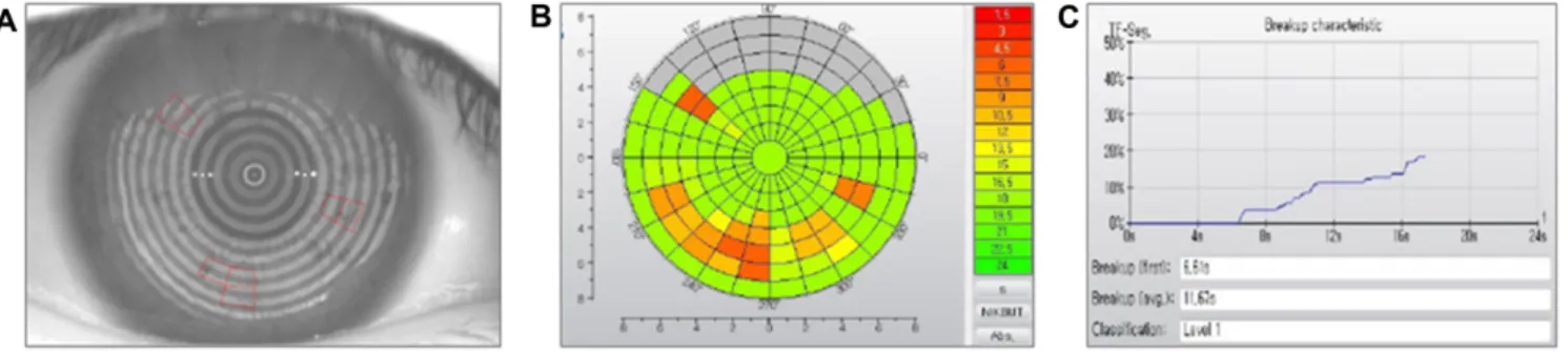 Fig. 2. The bulbar (A) and limbal areas (b) on the conjunctival surface for redness evaluation measured by Keratograph 5M.