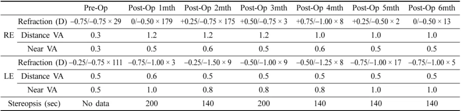 Fig. 2. Patient’s right eye (A and left eye (B) as photo-  graphed using a slit lamp.