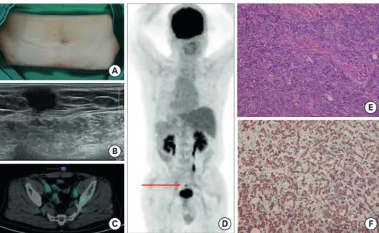 Figure 1. Clinical, imaging, and pathologic findings of ectopic male breast cancer. (A) Accessory nipple with mild  erythema of the mass