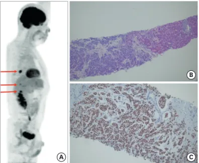 Figure 2. Imaging and pathologic findings of multiple metastases in the liver and pulmonary lymph node