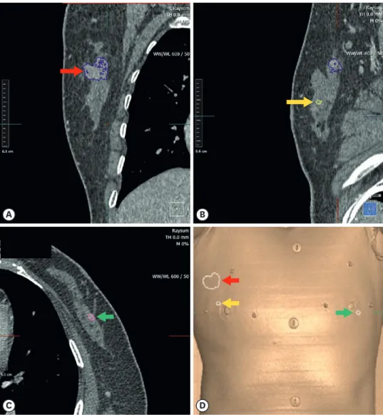 Figure 3. Data obtained from supine magnetic resonance imaging were analyzed, and the tumors, including the  right breast biopsy-confirmed cancer (A, D: red arrow) and the indeterminate tumors in the right breast (B, D: yellow  arrow), left breast (C, D: g