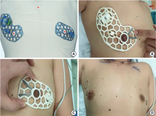 Figure 4. Patient-specific hybrid-type breast surgical guides (BSGs) containing the blue dye injection columns,  which can indicate the tumor extent requiring removal, are modeled (A)