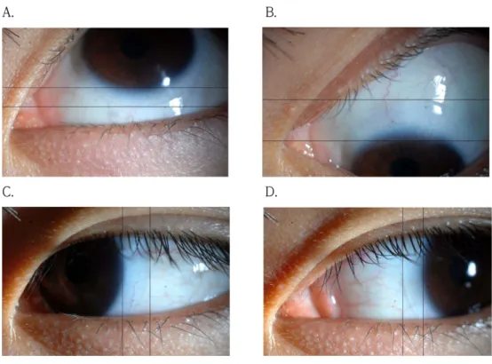Fig. 2. The measurement of lens lag on cornea in four gaze directions using a photoshop software.