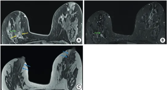 Figure 3. Breast MRI performed for evaluation of tumor response to NAC. (A) Axial T1-weighted fat-suppressed  postcontrast image demonstrates a decrease in tumor size, measuring 17 mm of maximum diameter (yellow  arrows)