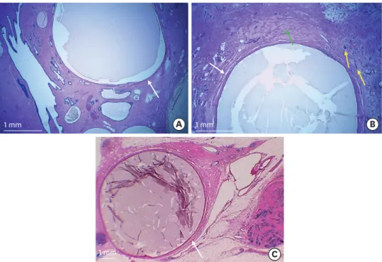 Figure 5. Histopathological examination of the surgical specimen showed diffuse ductal ectasia, most evident  in retroareolar location