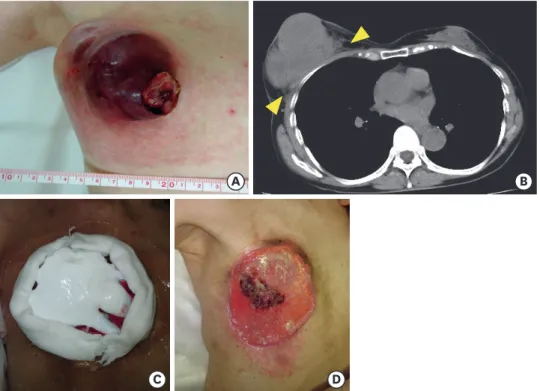 Figure 1. Macroscopic and CT image of the right breast at the initial visit and Mohs chemosurgery