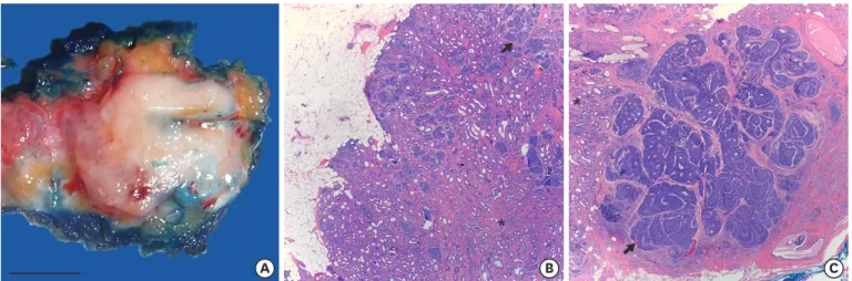 Figure 1. Macroscopic and microscopic pathology of the breast adenomyoepithelioma. (A) Gross (scale bar = 1 cm) and microscopic pathology of a breast  adenomyoepithelioma with (B) a benign component (asterisk) showing predominant tubular architecture growi