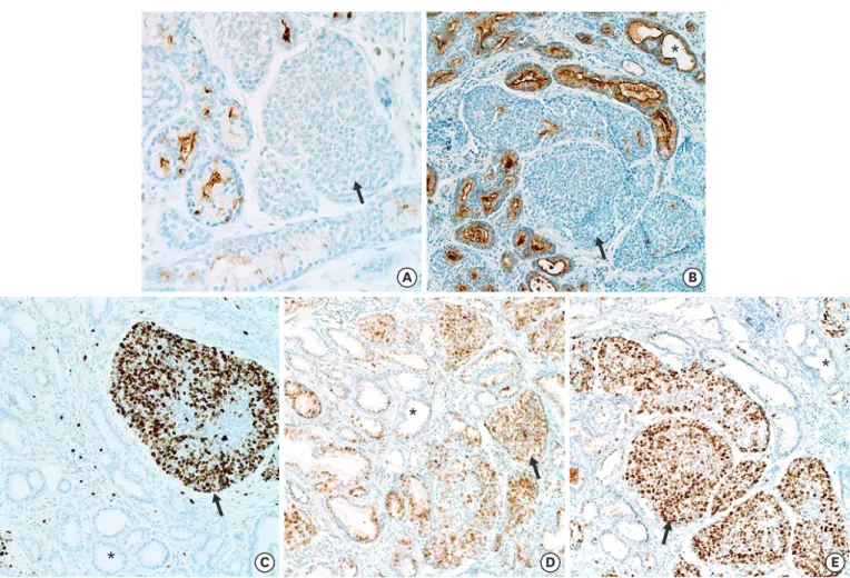 Figure 3. Immunohistochemical changes associated with malignant transformation in the adenomyoepithelioma