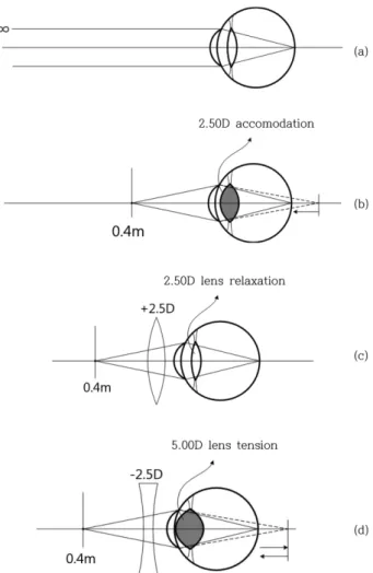 Table 2. Reaction of prism direction and lens type of optical system type of amblyopia 