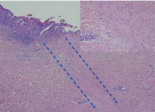 Figure 3. No dermal invasion and evidence of ectopic nipple, apocrine glands, or eccrine gland involvement