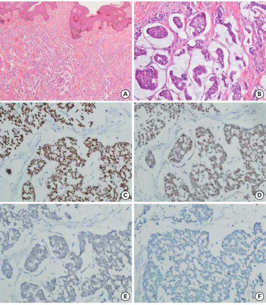 Figure 2. Representative features and immunohistochemical findings. (A) Irregular infiltration of tumor cell  clusters suspended in extracellular mucin at the sub-epidermal tissue (H&amp;E stain; ×20 on magnification)