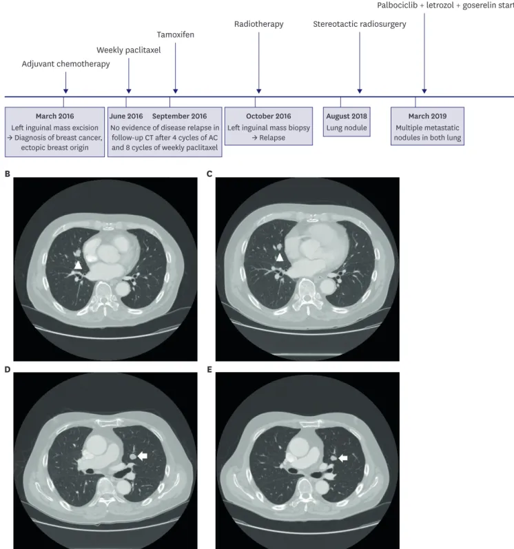 Figure 3. Timeline of treatment and lung nodules. (A) Summary of the overall treatment administered
