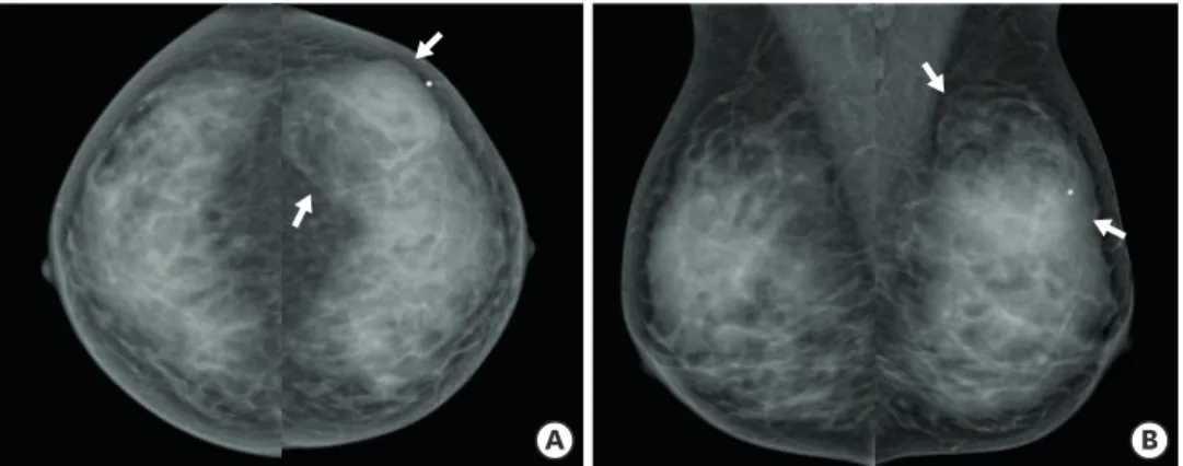 Figure 1. Craniocaudal (A) and mediolateral oblique (B) mammography showed an oval-shaped fat-containing  mass with an obscured margin in the left outer breast (arrows).