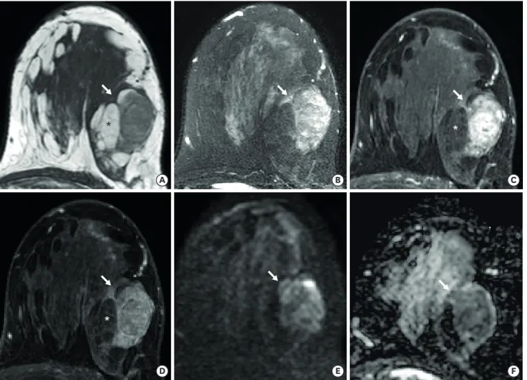 Figure 3. On axial T1-weighted (A) and T2-weighted image (B), the mass (arrows) showed heterogeneous signal intensity