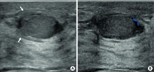Figure 5. Transverse ultrasonography (A) showed an oval-shaped isoechoic mass with indistinct margin (arrows)