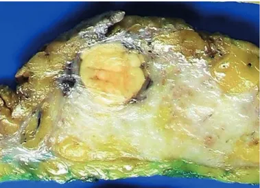 Figure 7. Mastectomy specimen showed well-circumscribed masses with a yellowish-white cut surface.
