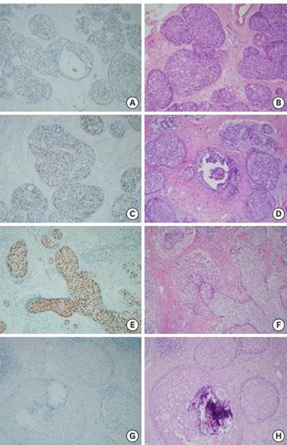 Figure 1. Immunohistochemistry and H&amp;E staining findings for AR. The presented slides are classified according to  the intensity of AR: (A), (C), (E) show cases with intensity 1, 2, 3, respectively