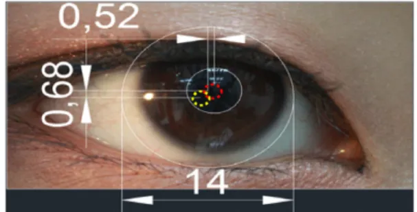Fig. 2. Measurement of lens lag with upper gaze.