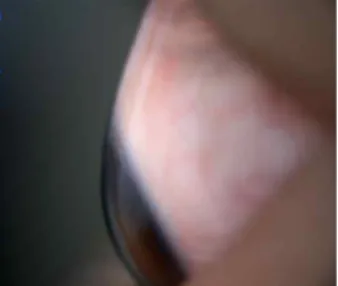 Fig. 2. Slit-lamp image of corneoscleral profile 1 on the superior  ocular surface.